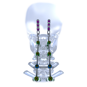 Sistem pelat tulang belakang serviks depan <span class=keywords><strong>Titanium</strong></span> ortopedi, implan bedah penyembuh fraktur tulang belakang perangkat medis pemutusan - Product Image 1