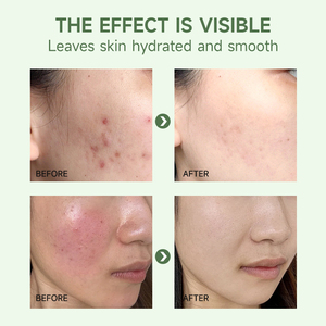 ครีมสมุนไพรรักษา<span class=keywords><strong>สิว</strong></span> OEM ODM ขนาด 1000 กรัม สูตรกรดซาลิไซลิก สำหรับ<span class=keywords><strong>รักษา</strong></span><span class=keywords><strong>สิว</strong></span> รอยแผลเป็น ควบคุมความมัน - Product Image 5