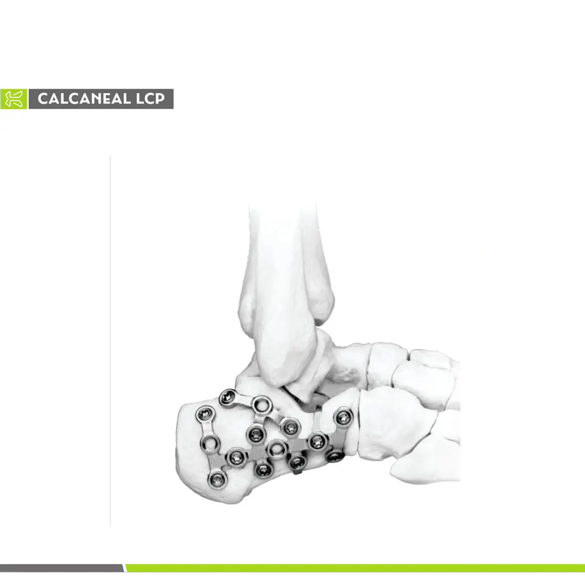 カルネアルロッキングコンプレッションプレートキネインサージカル整形外科外傷インプラント下肢大断片足首骨