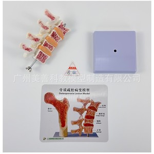 Simulation pédagogique de l'ostéoporose humaine, de la colonne vertébrale, des vertèbres lombaires, du squelette, de la structure osseuse, de la pathologie, des intervertèbres lombaires - Product Image 5