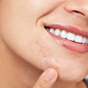 Bìa & chinh phục nhược điểm vá dễ thương Sao Holographic mụn vá tùy chỉnh salicylic axit chống mụn trứng cá Sticker - Product Image 3