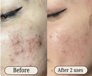 ชุดลอกผิวสีเขียวสำหรับผิวสิวเพื่อผิวหมองคล้ำ - Product Image 5