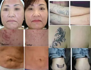 Máquina de depilación láser Nd Yag, máquina de eliminación de tatuajes y cejas, precio