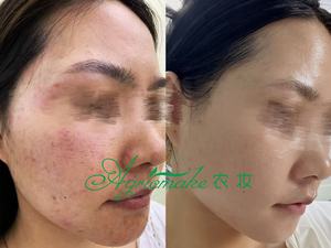 OEM ODM الأكثر مبيعاً علاج الوجه ميكرونيدلينغ حيوي مضاد للشيخوخة SQT Spongilla Spicules Biomicroneedling لعلاج صالون التجميل - Product Image 4