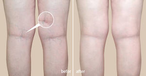 1470nm Máquina de eliminación de Cirugía de venas varicosas endovenosas láser de tratamiento de venas <span class=keywords><strong>vasculares</strong></span> de araña sin dolor - Product Image 6