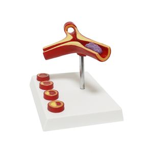 Modelo de Aterosclerosis y Trombosis Humana KyrenMed, Modelo Cardiovascular de Aterosclerosis Ampliado 10 Veces - Product Image 5