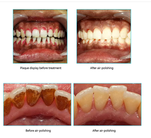 Appareil de détartrage dentaire, équipement de polissage à air pour dentiste, système de thérapie parodontale dentaire à écran tactile LCD, détartrage ultrasonique dentaire - Product Image 5