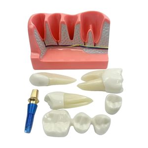 Modèle d'implant dentaire 4-en-1 avec couronne amovible, pont dentaire et facettes en porcelaine pour l'étude et la démonstration pédagogique - Product Image 3