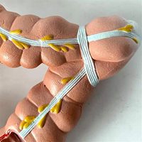 Modèle de maladie du côlon et du rectum humain KyrenMed, modèle pathologique de l'intestin grêle