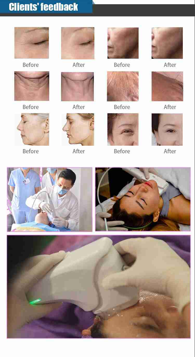 Hifu 7D Machine Vaginal Skin Tightening Rejuvenation 7D Hifu Machine