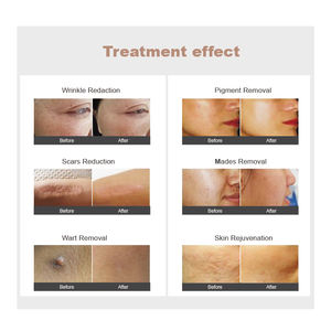 Laser Rumah Sakit CO2 Fraccionado Pengencang kulit fisioterapi 60w Laser Co2 fraksional mesin kecantikan untuk jerawat dan perawatan bekas luka - Product Image 6