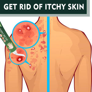 20g 천연 허브 가려움 방지 연고 건선 습진 발 손 몸 피부 완화 개인 관리 제품 - Product Image 3