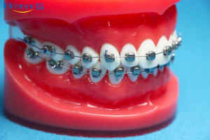 Shinye di vendita a caldo di alta qualità prezzo di fabbrica <span class=keywords><strong>ARC</strong></span> D supporto dentale autolegante staffa parentesi ortodontica - Product Image 4