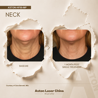 Máquina HIF Portátil, Dispositivo de Belleza Facial, Equipo de Cuidado Corporal para Clínica de Belleza y Salón