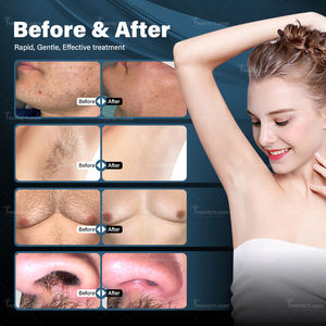 เครื่องกำจัดขนด้วยเลเซอร์ไอซ์ไทเทเนียม 755nm 808nm 940nm 1064nm ระดับมืออาชีพ 4 ความยาวคลื่น กำจัดขนถาวรด้วยเลเซอร์ไดโอด - Product Image 6