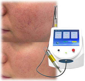 Laser Endoskin lifting du <span class=keywords><strong>visage</strong></span> 980nm Lipo vérifier ascenseur Fiber élimination des graisses perte de poids corps sculptra Endolaser laser médical facial - Product Image 4