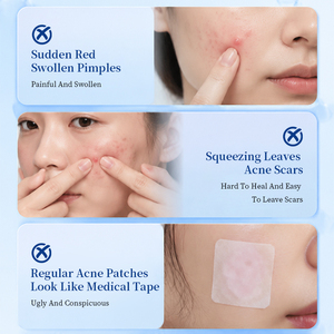 Parche de Hidrocoloide Azul Personalizado para el Acné, Absorbe el Exceso de Sebo y Pus, Aísla la Suciedad para Proteger la Piel con Imperfecciones Durante Todo el Día - Product Image 2