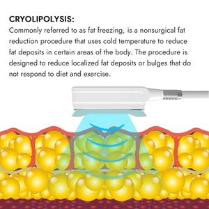 Appareil de <span class=keywords><strong>cryolipolyse</strong></span> Synogal à <span class=keywords><strong>prix</strong></span> d'usine, lumière LED 360°, cryothérapie corporelle, beauté PDT, congélation des graisses - Product Image 2