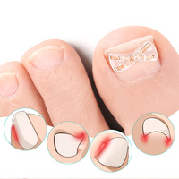 Correcteur d'ongles incarnés invisible en forme de X, léger, en alliage de nickel, auto-adhésif, pour l'hiver, vente en gros