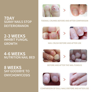 Tratamiento Herbal Antihongos <span class=keywords><strong>para</strong></span> <span class=keywords><strong>Uñas</strong></span> <span class=keywords><strong>de</strong></span> Marca Privada, Suero <span class=keywords><strong>para</strong></span> el Cuidado <span class=keywords><strong>de</strong></span> <span class=keywords><strong>los</strong></span> Pies, Onicomicosis, Paroniquia, Loción <span class=keywords><strong>para</strong></span> <span class=keywords><strong>Hongos</strong></span> en <span class=keywords><strong>las</strong></span> <span class=keywords><strong>Uñas</strong></span> - Product Image 3