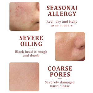 Sérum facial à la calendula AFCARE, essence faciale <span class=keywords><strong>contenant</strong></span> <span class=keywords><strong>de</strong></span> <span class=keywords><strong>l</strong></span>'<span class=keywords><strong>acide</strong></span> <span class=keywords><strong>salicylique</strong></span>, sérum réparateur contre <span class=keywords><strong>l</strong></span>'acné, huile pour réduire les pores, éliminer les points noirs, nettoyage - Product Image 4