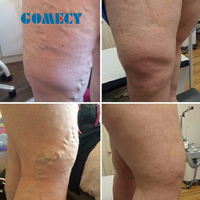 Traitement laser endoveineux des varices EVLT, machine laser 1470 nm