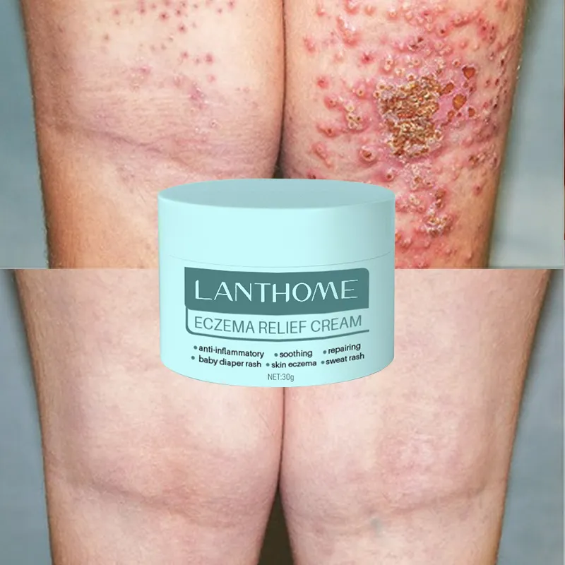 Marque privée végétalien anti démangeaisons traitement Psoriasis crème hydratante traitement de l'eczéma herbes eczéma crème pour bébés