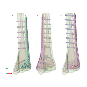 Implantes Ortopédicos Quirúrgicos Manuales de Titanio para Tibia Distal, con Bloqueo Intramedular Multidimensional, Eficaz para Traumatismos - Product Image 4