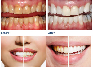 Laser gusi operasi gigi jaringan lembut 980nm dioda Laser pemutih gigi Endo Oral 980nm klinik kedokteran gigi operasi medis - Product Image 6