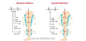 Dispositif médical externe de contre-pulsation (ECP ou EECP) pour la douleur thoracique et le calcium coronaire pour éviter la chirurgie de pontage - Product Image 6