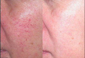 Alta potencia 30W KTP532mm láser eliminación vascular vasos sanguíneos eliminación de <span class=keywords><strong>arañas</strong></span> <span class=keywords><strong>vasculares</strong></span> 980nm máquina láser de diodo - Product Image 6