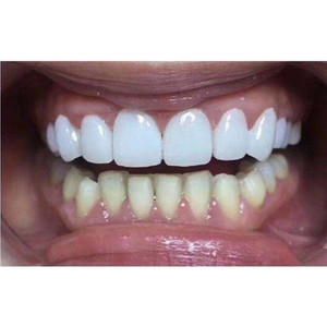 SowSmile-cubierta de reparación para dentaduras, accesorio temporal y Real instantáneo perfecto para el cuidado bucal Dental, con broche de sonrisa, dentaduras postizas - Product Image 5