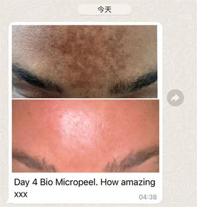 Kit Profesional <span class=keywords><strong>de</strong></span> Microagujas Bio ODM OEM 90% con <span class=keywords><strong>Peeling</strong></span> <span class=keywords><strong>Natural</strong></span> <span class=keywords><strong>de</strong></span> <span class=keywords><strong>Algas</strong></span>, Tratamiento <span class=keywords><strong>de</strong></span> Espículas <span class=keywords><strong>de</strong></span> Esponja - Product Image 6