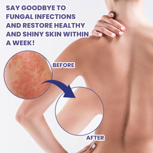 ครีมทาผื่นจากเชื้อรา aati 3วันบรรเทาอาการตะไคร่น้ำสีแดงและอาการ<span class=keywords><strong>คัน</strong></span>ให้ความชุ่มชื้นดูแลผิว - Product Image 3