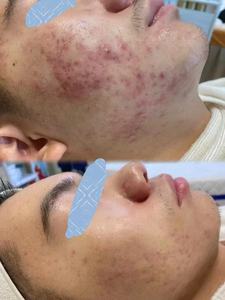 Productos para el cuidado de la piel a granel de fábrica para el tratamiento del removedor del acné Suero Anti Acné Parche de espinillas Acné para el cuidado facial de las espinillas - Product Image 4