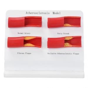 Modelo de Aterosclerosis, Juego de Modelos de Arterias, Progresión de Enfermedades Vasculares en 4 Etapas, Modelo Anatómico para Enseñanza Médica - Product Image 5