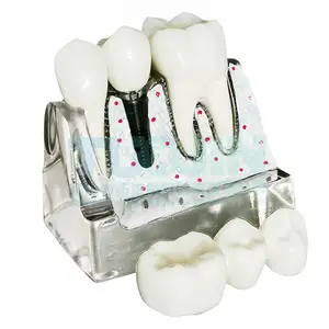 2.5 Times Larger Implant Restoration Demonstration Model Crown And Bridge Abutment Crown Removable For Dental Clinics