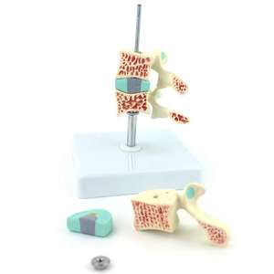 Gelsonlab HSBM-139 Tulang Belakang Model Anatomi, Model Osteoporosis, Ntervertebral Disc Model Perut Ortopedi Nyeri Model - Product Image 4