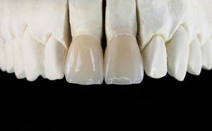 Dentisterie Esthétique Chine Dentaire <span class=keywords><strong>Prix</strong></span> Usine Dents Artificielles Personnalisé Pfm Dentaire Métal <span class=keywords><strong>Céramique</strong></span> <span class=keywords><strong>Couronne</strong></span> - Product Image 2