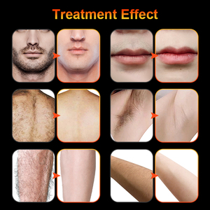 เข็มอิเล็กโทรไลซิสผสมทองคำกำจัดขน100สำหรับสปาเสริมความงาม - Product Image 5