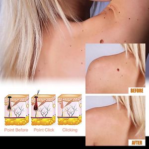 Líquido para <span class=keywords><strong>Eliminar</strong></span> <span class=keywords><strong>Verrugas</strong></span>, Gel Exira Sirengthen para <span class=keywords><strong>Eliminar</strong></span> Callosidades - Product Image 6