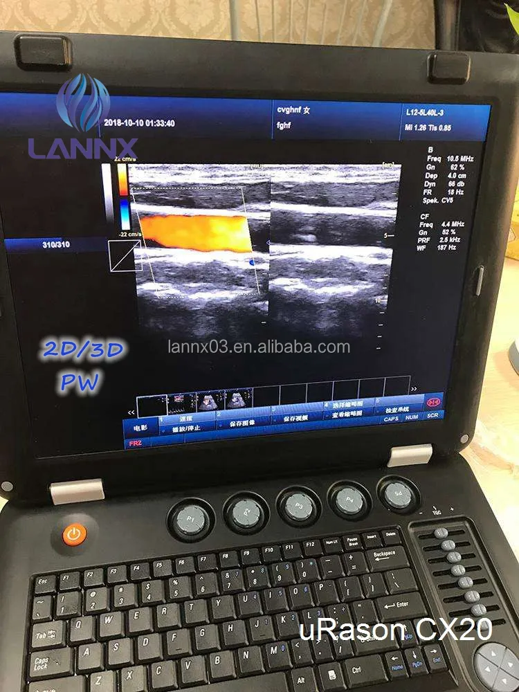 LANNX uRason CX20 Portable Digital Diagnostic Color Doppler 2D/3D optional Ultrasound Scanner System for hospital ultrasonido