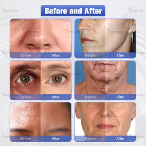 Máy chăm sóc da mặt Hydra Dermabrasion 10 trong 1, làm sạch sâu lỗ chân lông, thu nhỏ lỗ chân lông, xóa nhăn, thiết bị thẩm mỹ viện - Product Image 5