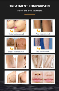 Equipamento Estético Médico Opt <span class=keywords><strong>Ipl</strong></span> Máquina De Remoção De Rugas De Rejuvenescimento De Pele Máquina De Remoção De Cabelo <span class=keywords><strong>Ipl</strong></span> - Product Image 5