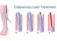 Traitement au laser pour les varices EVLT, ablation endoveineuse, 980 nm 1470 nm, 45W/30W, mini-invasif, fabricant CE MDR