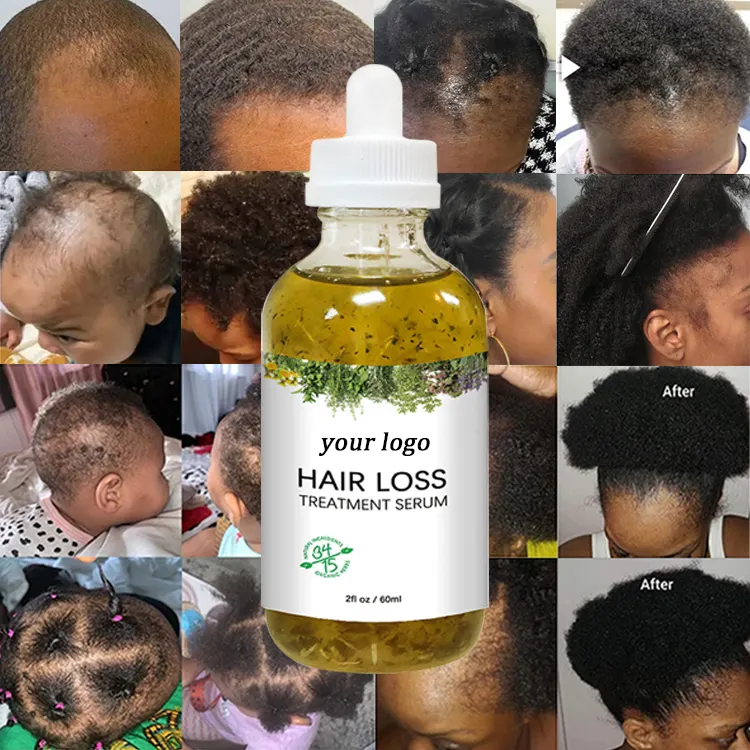 China Best 7days Ginger Veganic Natural Rosemary Essential Hair Growth Oil Jamaican Black Castor Oil for Hair Growth Men'S