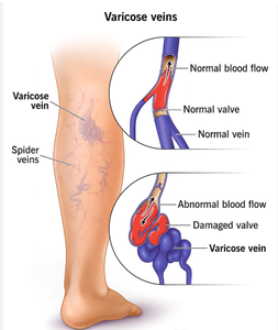 Máquina de Eliminación de Venas Varicosas con Láser Endovenoso EVLT de Fibra Óptica de 980nm+1470nm, <span class=keywords><strong>Tratamiento</strong></span> Láser para Venas Varicosas - Product Image 4