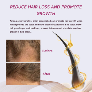 2025 Bán hàng nóng tăng trưởng tóc đỏ hành tây dầu hạt đen điều trị da đầu chống tóc mùa thu hành tây đỏ Volumizing tóc mọc lại dầu - Product Image 3