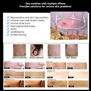 2024 máquina láser de <span class=keywords><strong>CO2</strong></span> más nueva láser <span class=keywords><strong>CO2</strong></span> fraccional, equipo láser <span class=keywords><strong>CO2</strong></span> fraccional, láser <span class=keywords><strong>CO2</strong></span> - Product Image 4