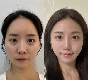 חומרי מילוי תת-עורית למקדשים, קפלי nasolabial וחדרי לחי - Product Image 6